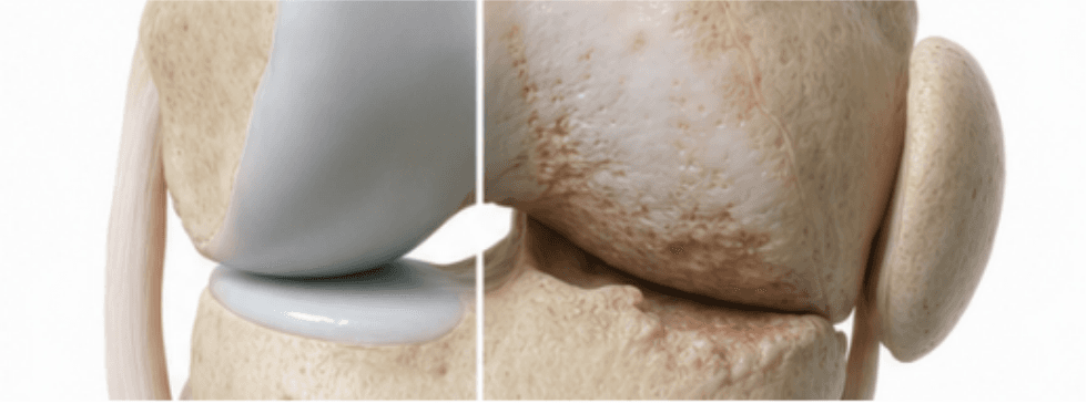 정상 무릎과 퇴행성 관절염 무릎 구조를 비교한 3D 의료 일러스트