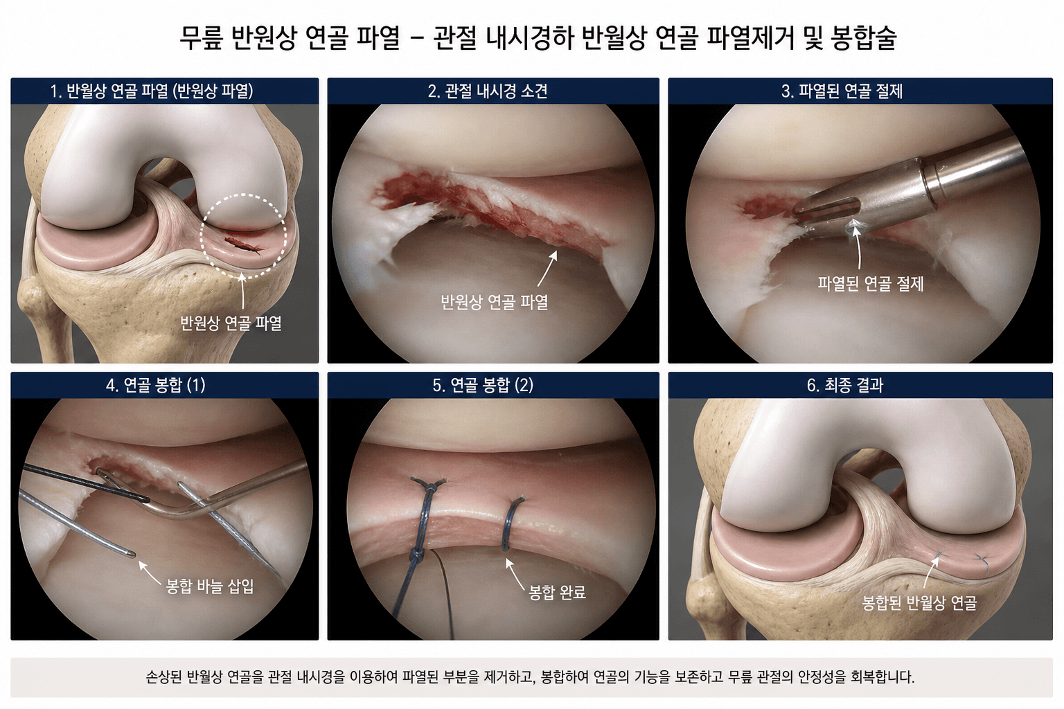 관절경으로 반월상 연골판의 불안정한 손상 조직을 필요한 범위만 정리하는 과정과 봉합 가능한 파열을 봉합하는 과정을 각각 나타낸 3D 의료 일러스트