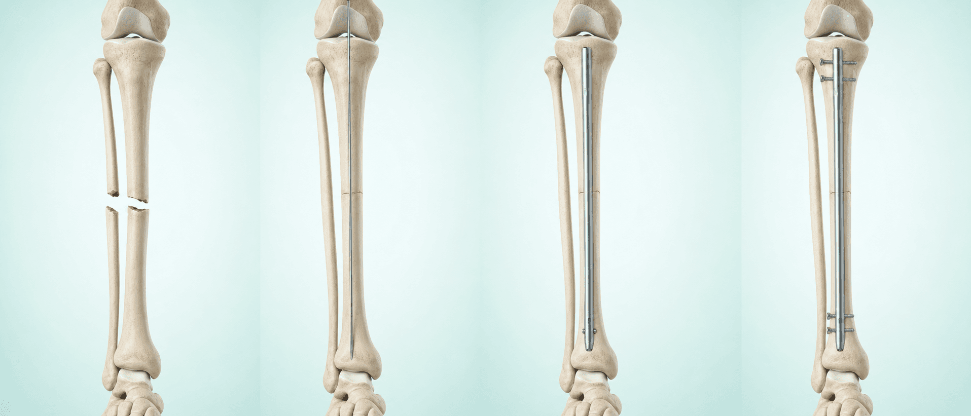 경골 골수강에 금속정을 삽입하고 잠금 나사로 고정하는 과정을 나타낸 AI 기반 3D 의료 일러스트